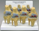 4-Stage Osteoarthritis Knee Model
